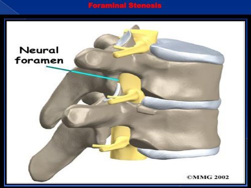 Spinal stenosis