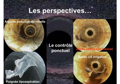 Nettoyage des instruments Nettoyage des instruments creux: le ...