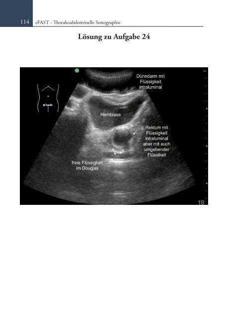 Sonoskopie eFAST: Lungensonographie und FAST (Online Auflage).