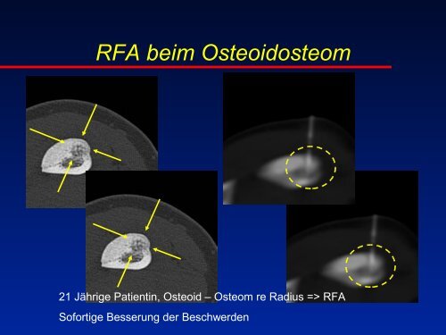 RFA beim Osteoidosteom - olbert-workshop
