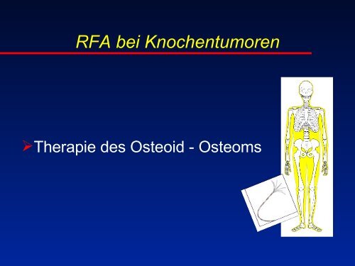 RFA beim Osteoidosteom - olbert-workshop