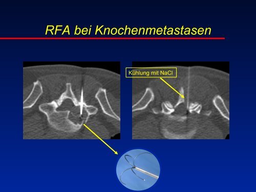 RFA beim Osteoidosteom - olbert-workshop