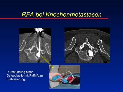 RFA beim Osteoidosteom - olbert-workshop