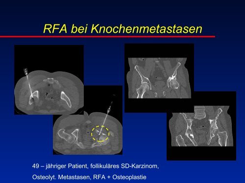 RFA beim Osteoidosteom - olbert-workshop