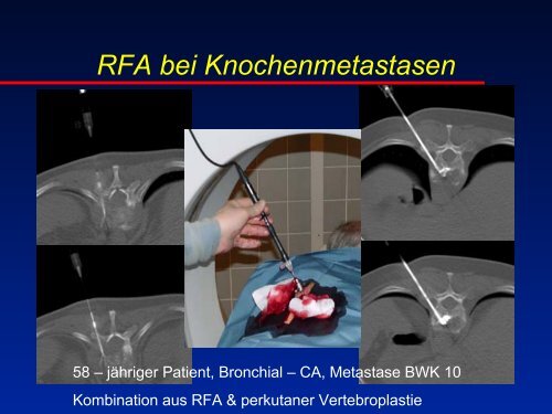 RFA beim Osteoidosteom - olbert-workshop