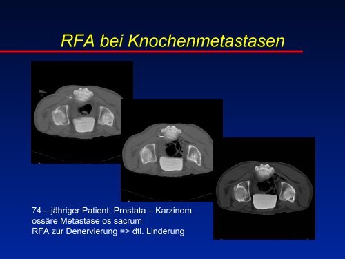 RFA beim Osteoidosteom - olbert-workshop