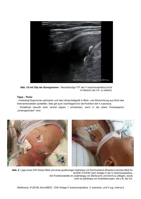 ZVK-Anlage: Variationen der Point-of-Care Ultraschall Verfahren V. brachiocephalica, V. subclavia und VJI