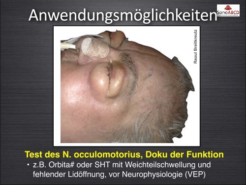 D-Probleme: Sonoskopie des ONSD, Pupillomotorik und mehr....
