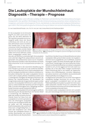 Die Leukoplakie der Mundschleimhaut: Diagnostik ... - Akopom