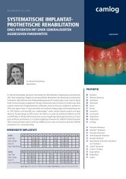 systematische implantat- prothetische rehabilitation - Alltec Dental