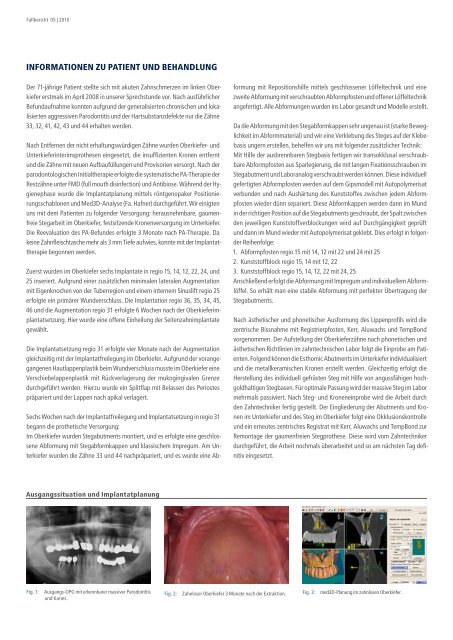 systematische implantat- prothetische rehabilitation - Alltec Dental