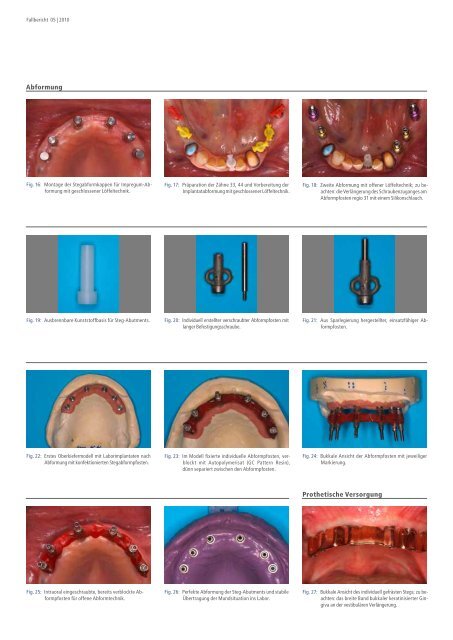 systematische implantat- prothetische rehabilitation - Alltec Dental