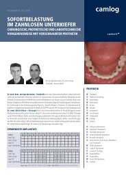 SofortbelaStung im ZahnloSen unterkiefer - Alltec Dental