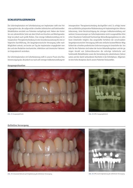 SofortbelaStung im ZahnloSen unterkiefer - Alltec Dental