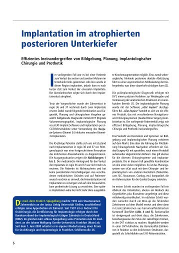 Implantation im atrophierten posterioren Unterkiefer - Dr. med. dent ...