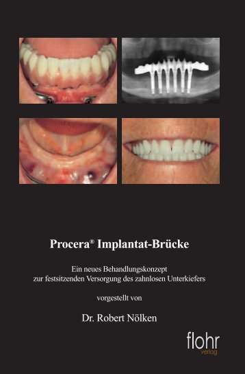 Procera® Implantat-Brücke - Dr. Robert Nölken