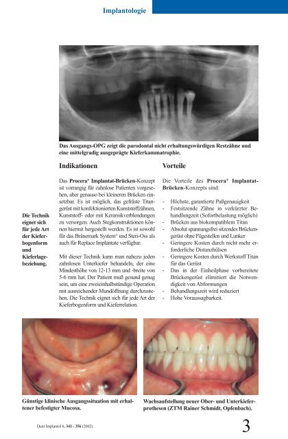 Procera® Implantat-Brücke - Dr. Robert Nölken