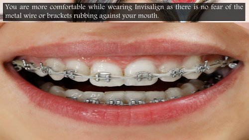 Why is Invisalign a Better Option than Metal Braces