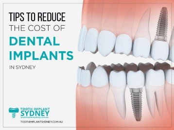 Cost of Dental Implants in Sydney - Tooth Implant Sydney