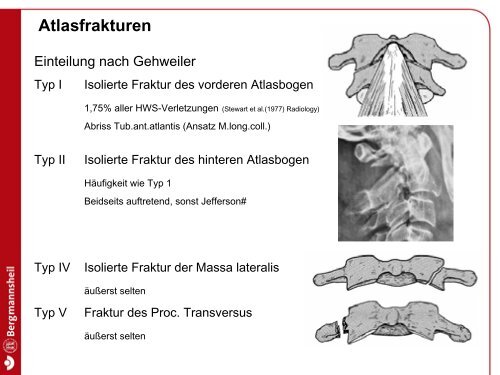 Axisbogen-Frakturen