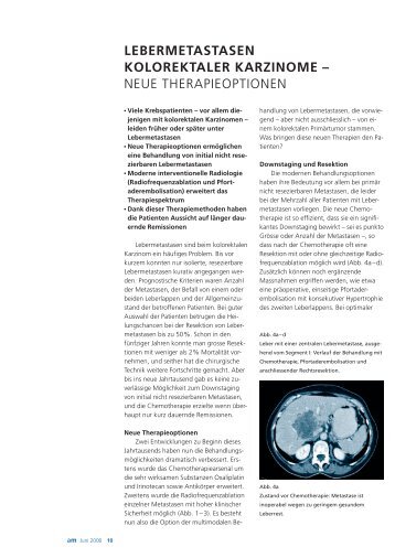 aktuelle-medizin-lebermetastasen