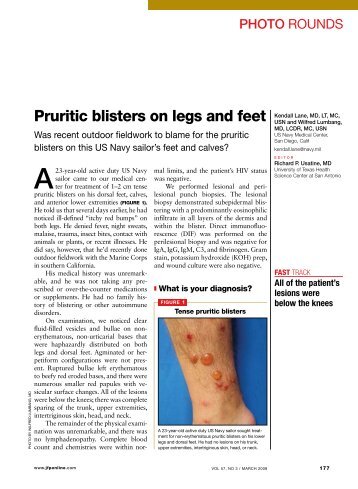 Pruritic blisters on legs and feet - The Journal of Family Practice