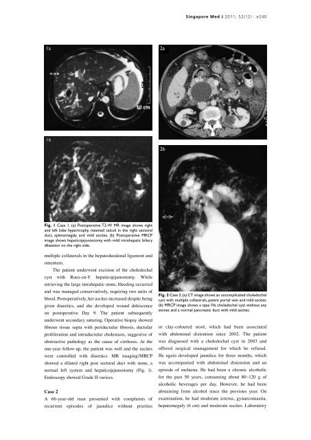 Management of choledochal cyst with portal ... - APAMED Central