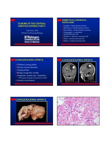 GANGLIOGLIOMA (WHO I) GANGLIOGLIOMA (WHO I)