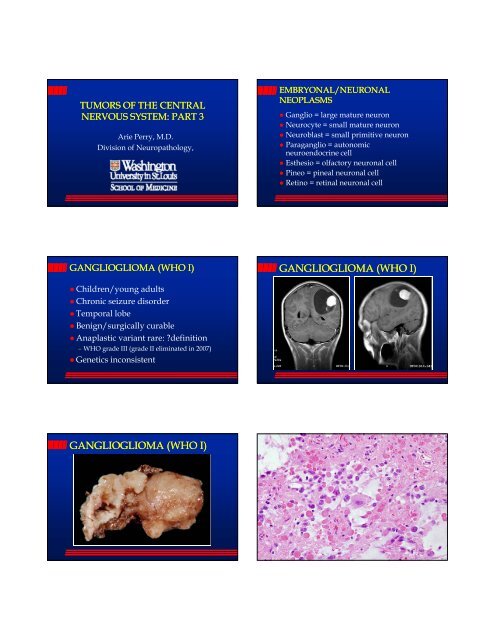 GANGLIOGLIOMA (WHO I) GANGLIOGLIOMA (WHO I)