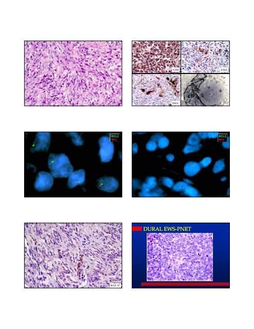 GANGLIOGLIOMA (WHO I) GANGLIOGLIOMA (WHO I)