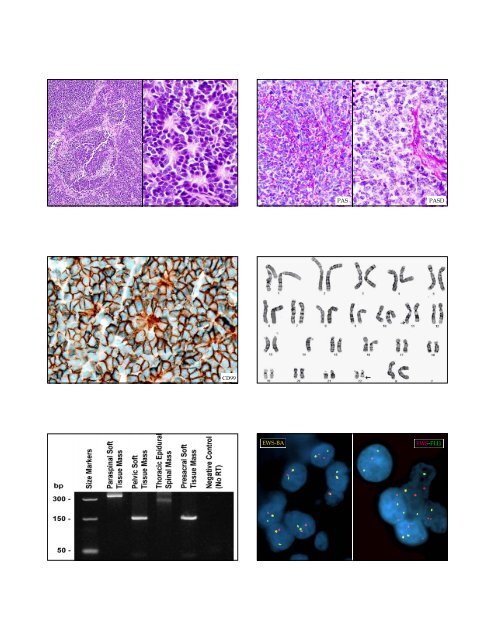 GANGLIOGLIOMA (WHO I) GANGLIOGLIOMA (WHO I)