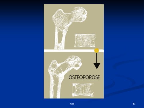 OSTEOPOROSE - Dr. Kurt A. Moosburger