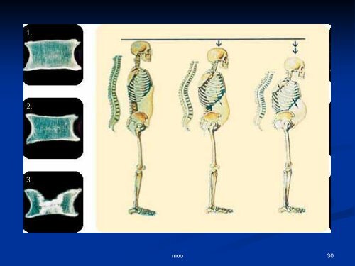 OSTEOPOROSE - Dr. Kurt A. Moosburger