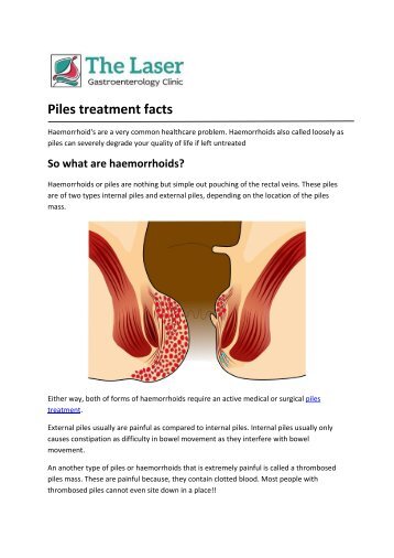 Piles treatment