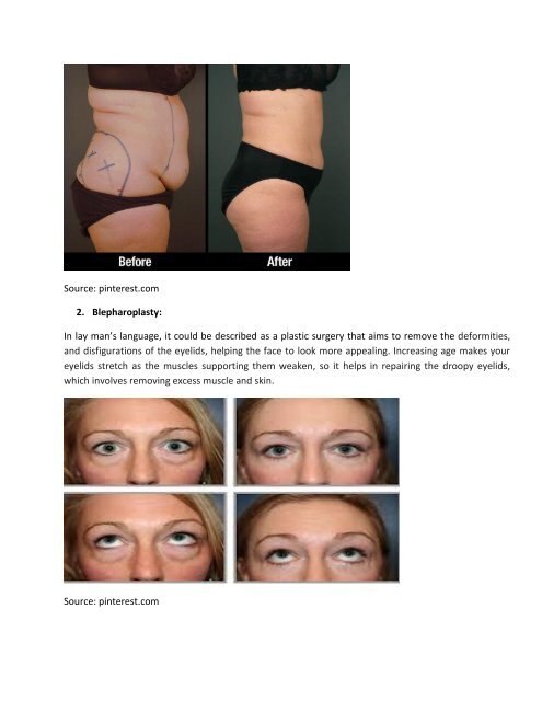 NOT ALL ABOUT INNER BEAUTY — KNOW ALL ABOUT LIPOSUCTION AND BLEPHAROPLASTY