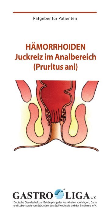 HÄMORRHOIDEN Juckreiz im Analbereich (Pruritus ani)  - Gastro Liga