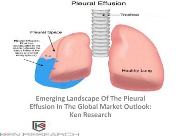 Global Pleural effusion Market Research Report, Analysis, Opportunities, Forecast, Size, Segmentation, Competitive Analysis : Ken Research