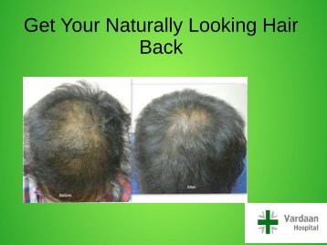 Hair Transplant Cost Delhi