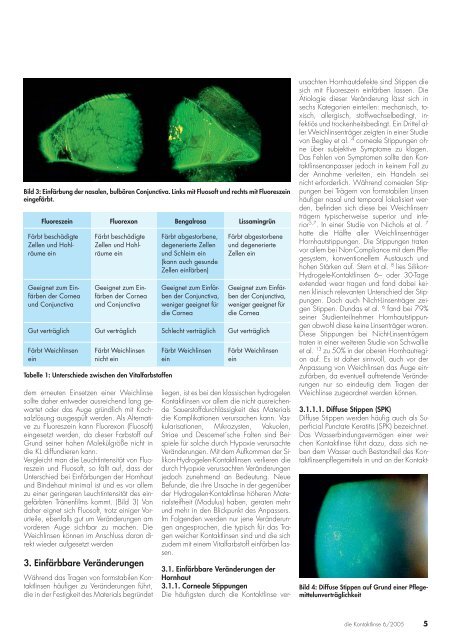 Fluoreszeineinfärbungen nach dem Tragen weicher Kontaktlinsen