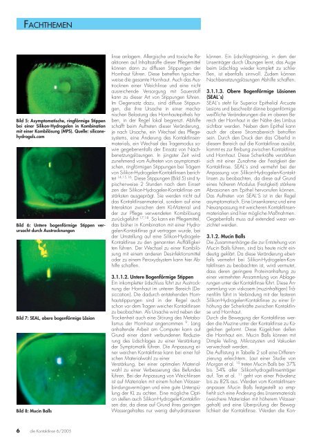 Fluoreszeineinfärbungen nach dem Tragen weicher Kontaktlinsen