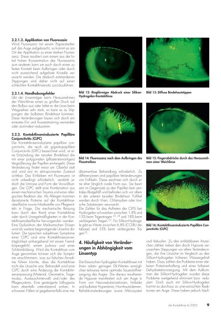 Fluoreszeineinfärbungen nach dem Tragen weicher Kontaktlinsen