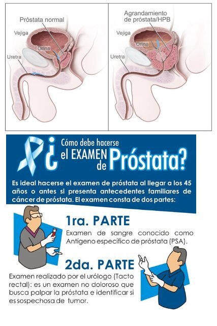 examen de sangre cancer de prostata)