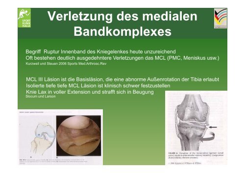 Kniebinnenschäden Kniebinnenschäden - Sportklinik Halle