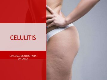 Maria Eugenia Baptista Zacarías - Celulitis