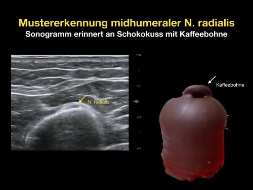 Rescue Blocks_Kapitel_1.1_Radialis Block midhumeral