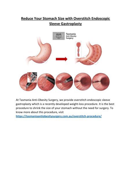 Reduce Your Stomach Size with Overstitch Endoscopic Sleeve Gastroplasty