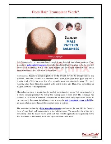 Does Hair Transplant Work?