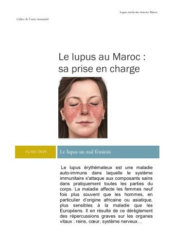 Le lupus  au Maroc :  sa prise en charge