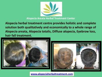 Alopecia Areata Herbal Treatment