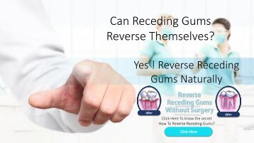Cost To Reverse Receding Gums